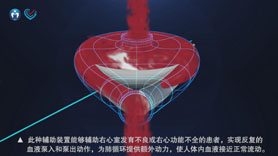 右心室辅助装置